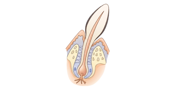 2ème étape : Déclenchement d'une réaction inflammatoire et de la gingivite